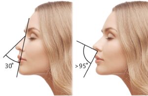 rhinoplasty