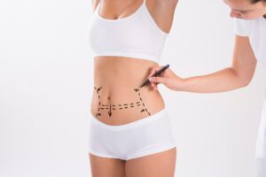 tummy tuck